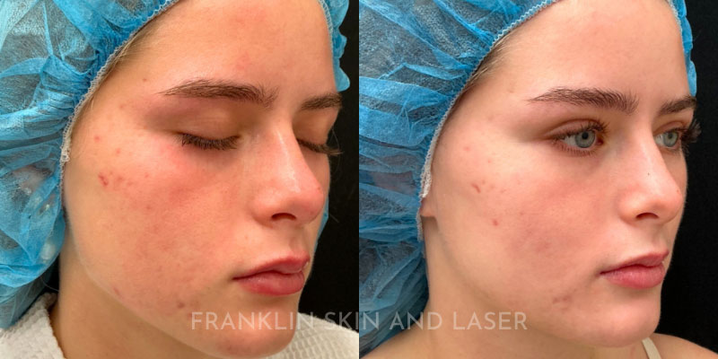 Photorejuvenation Before & After Image