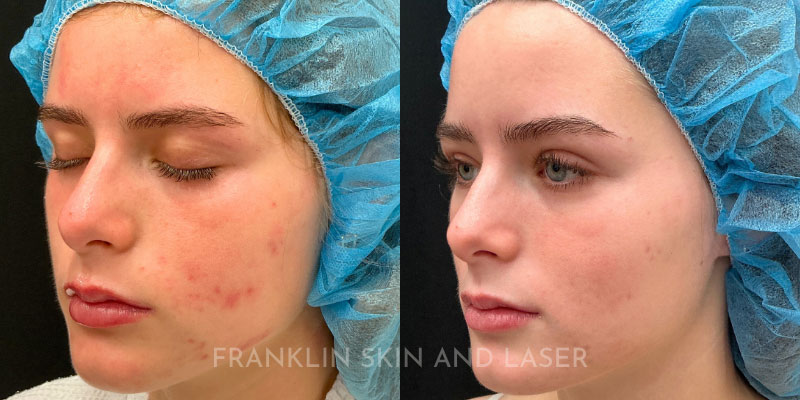 Photorejuvenation Before & After Image