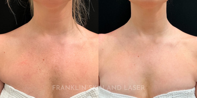 Photorejuvenation Before & After Image