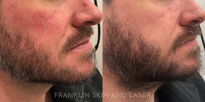 Photorejuvenation Before & After Image