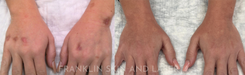 Photorejuvenation Before & After Image