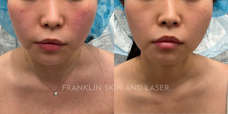 Photorejuvenation Before & After Image