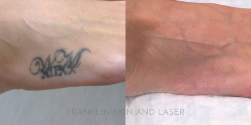 Tattoo Removal Before & After Image