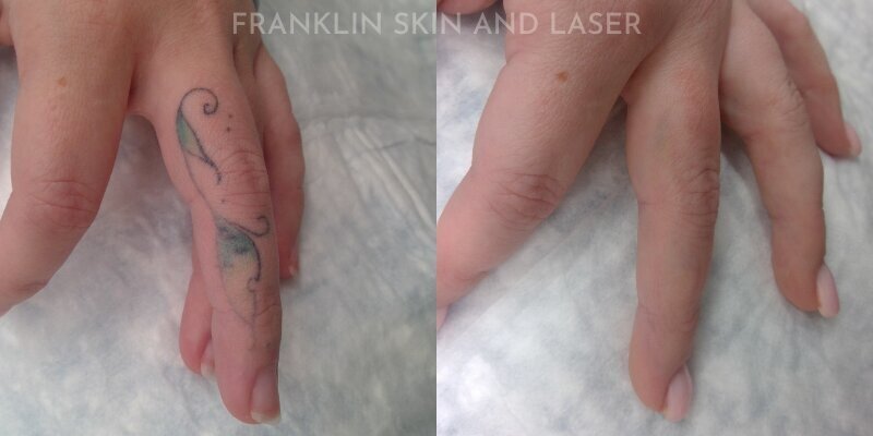 Tattoo Removal Before & After Image