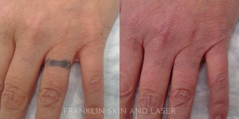 Tattoo Removal Before & After Image