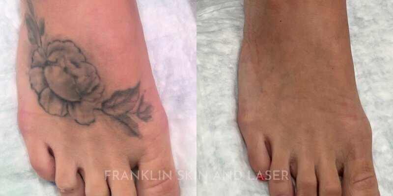 Tattoo Removal Before & After Image