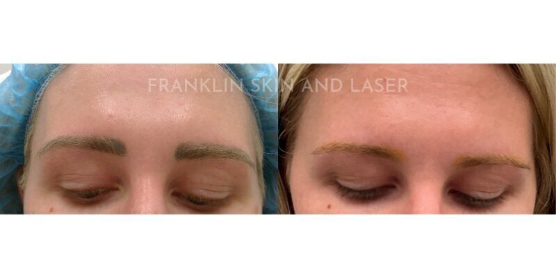 Tattoo Removal Before & After Image