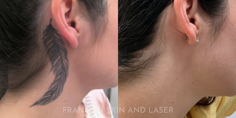 Tattoo Removal Before & After Image