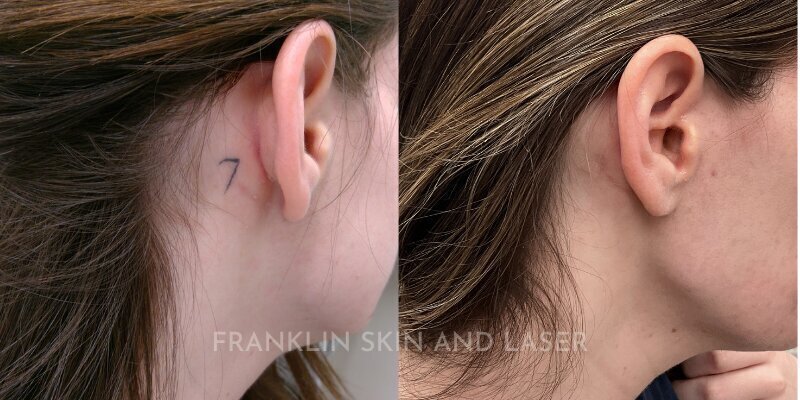 Tattoo Removal Before & After Image